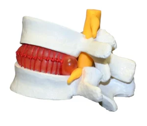 Prolapsed Intervertebral Disc